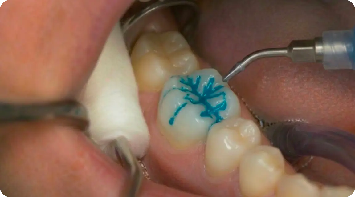 Etchant Application